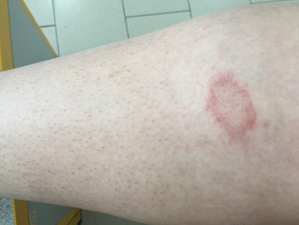 Roten Fleck Am Bein Habe Ziemliche Angst Krebs Flecken Roten Fleck Am Bein Habe Ziemliche Angst Krebs Flecken