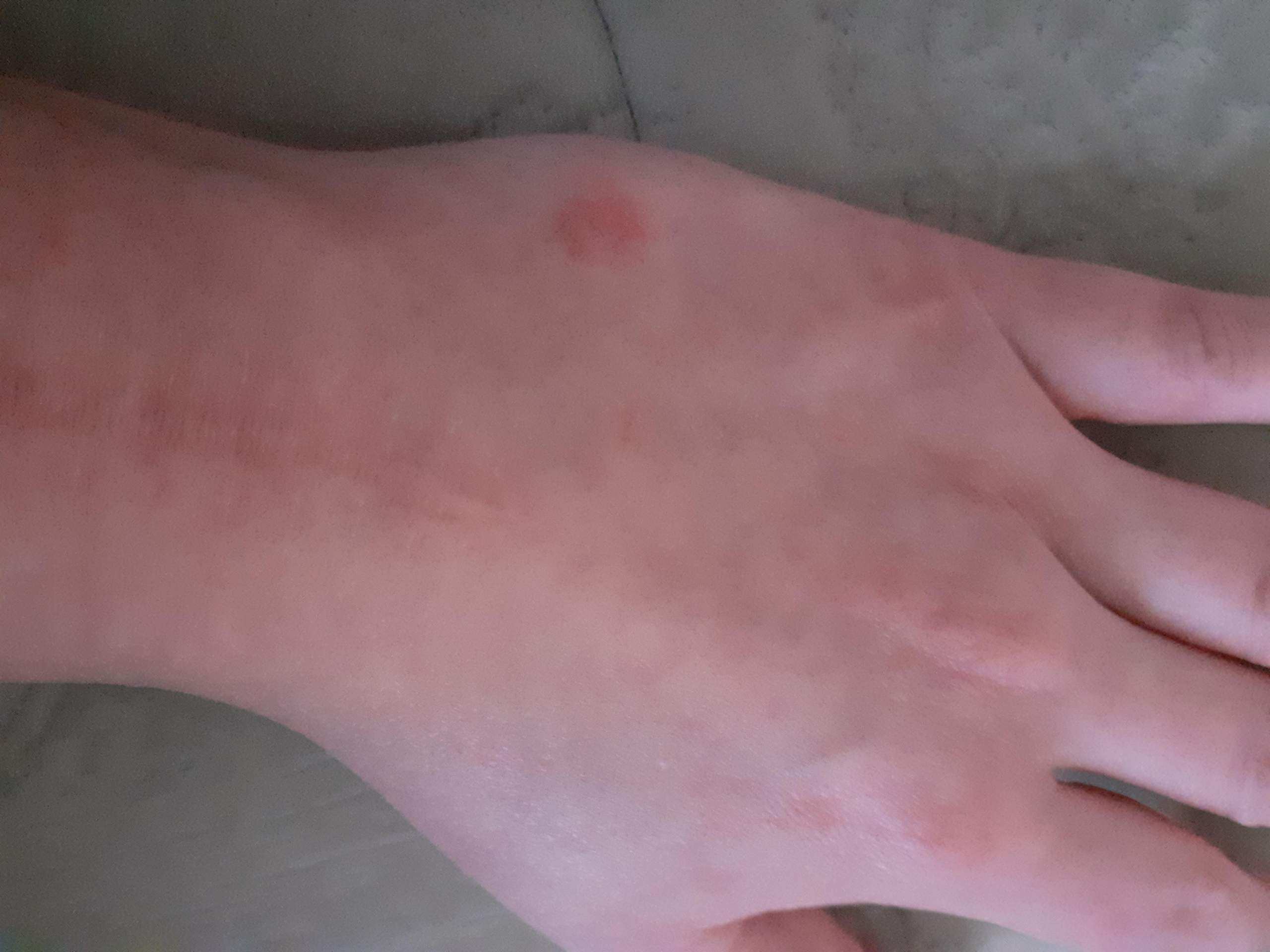 Roten Fleck auf der Haut (Hand)? (rote flecken)