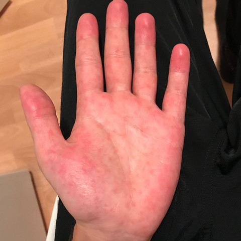 Hand Innenseite  - (Gesundheit und Medizin, Hautkrankheit, rote flecken)