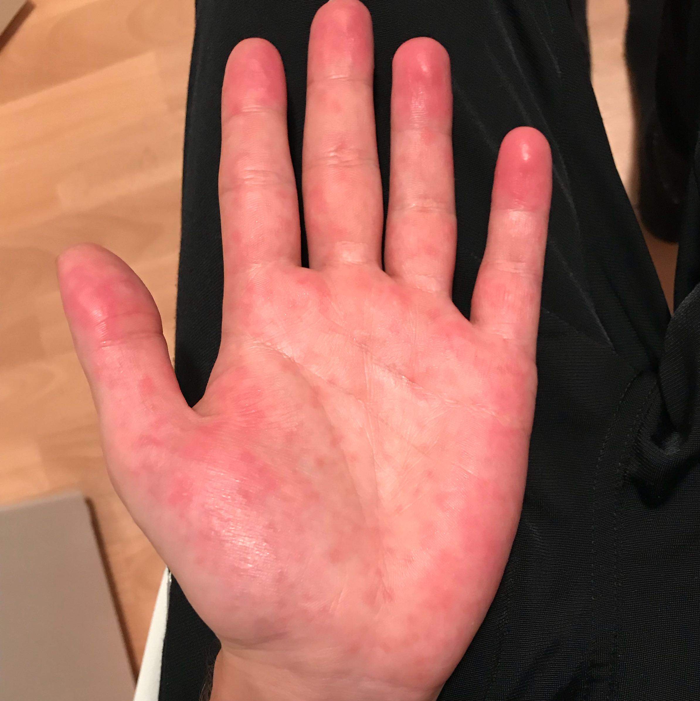 Alkohol bei rote flecken Alkoholunverträglichkeit