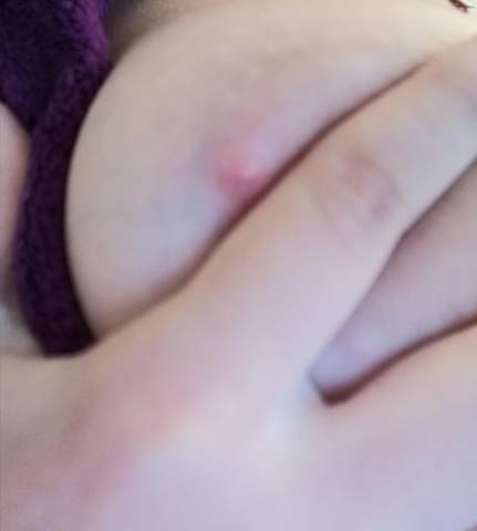 Roten Pickel An Der Brust Roten Pickel An Der Brust