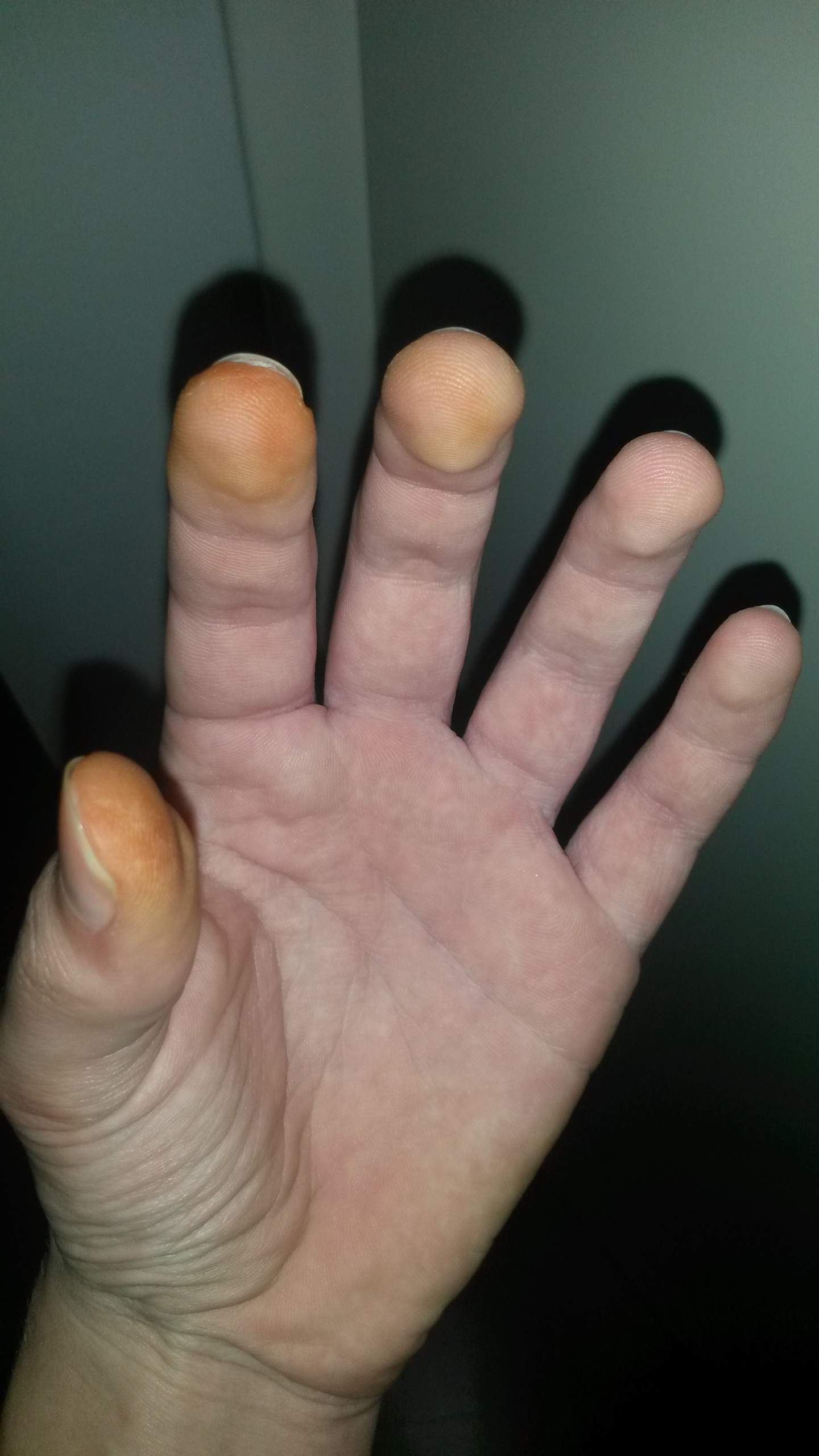 rote/orange finger (Gesundheit)