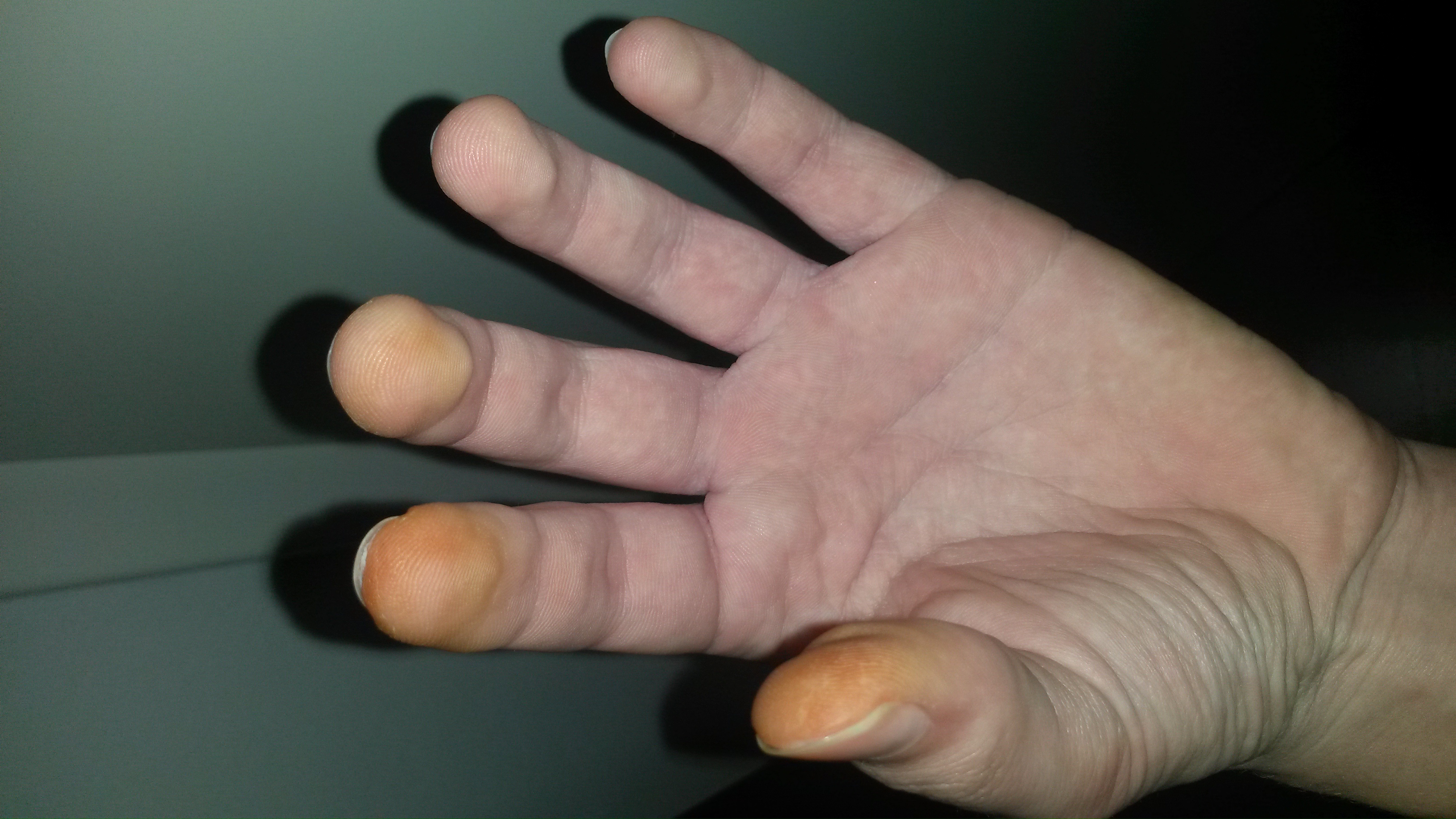 rote/orange finger (Gesundheit)