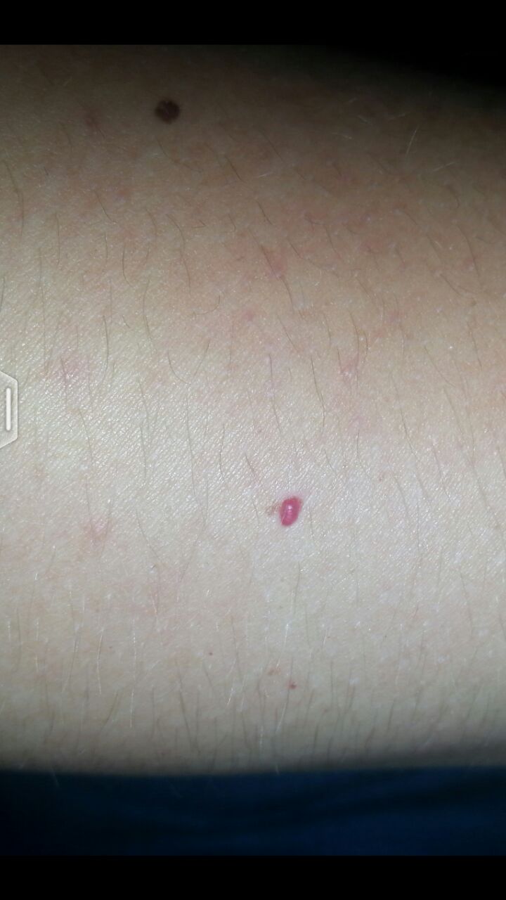 Rote/Pinke Blase auf der Haut? Ist das ansteckend? (Krankheit, rot