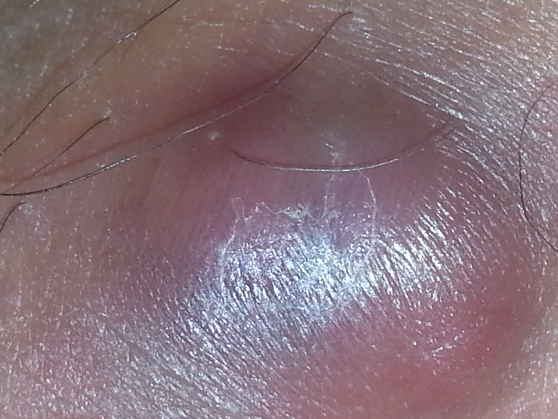 Roter schmerzender Knubbel an Oberschenkel Hilfe ...