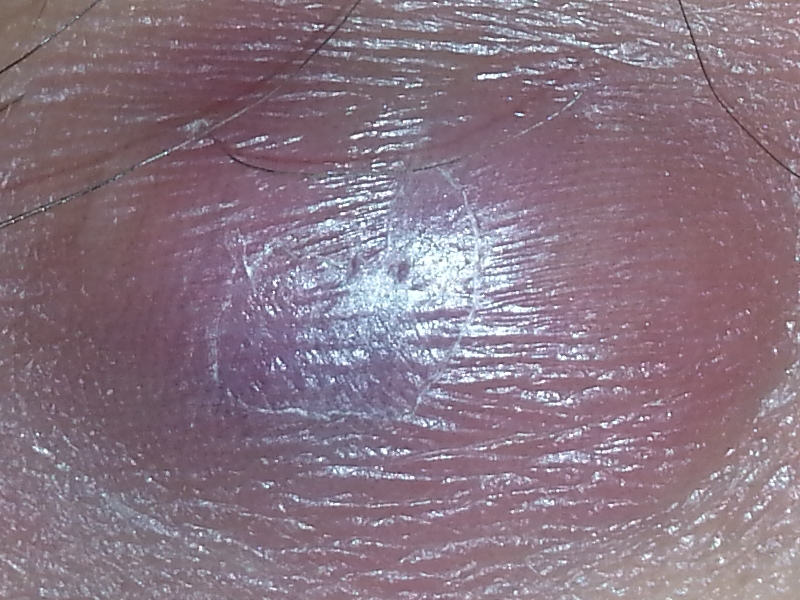 86 Schmerzender Pickel Innere Schamlippe 2021 Photos 86 Schmerzender Pickel Innere Schamlippe 2021 Photos