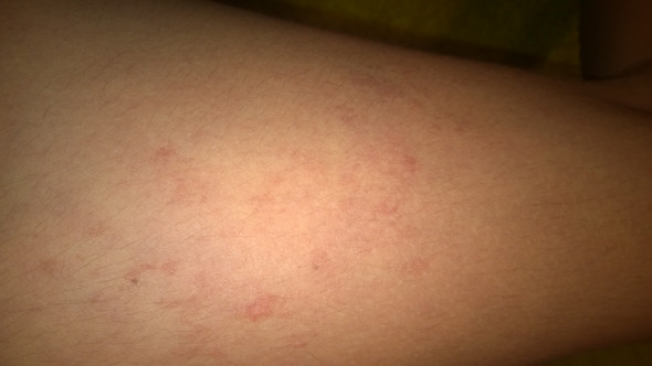 Roter Ausschlag am Bein? was ist das ? (rot) Roter Ausschlag am Bein? was ist das ? (rot)