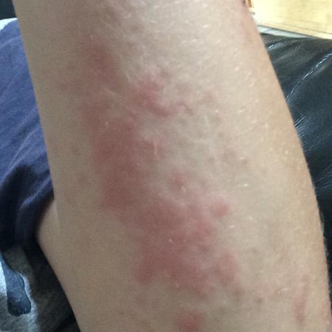 Roter Ausschlag Am Ganzen Korper Was Tun Arbeit Medizin Arzt Roter Ausschlag Am Ganzen Korper Was Tun Arbeit Medizin Arzt