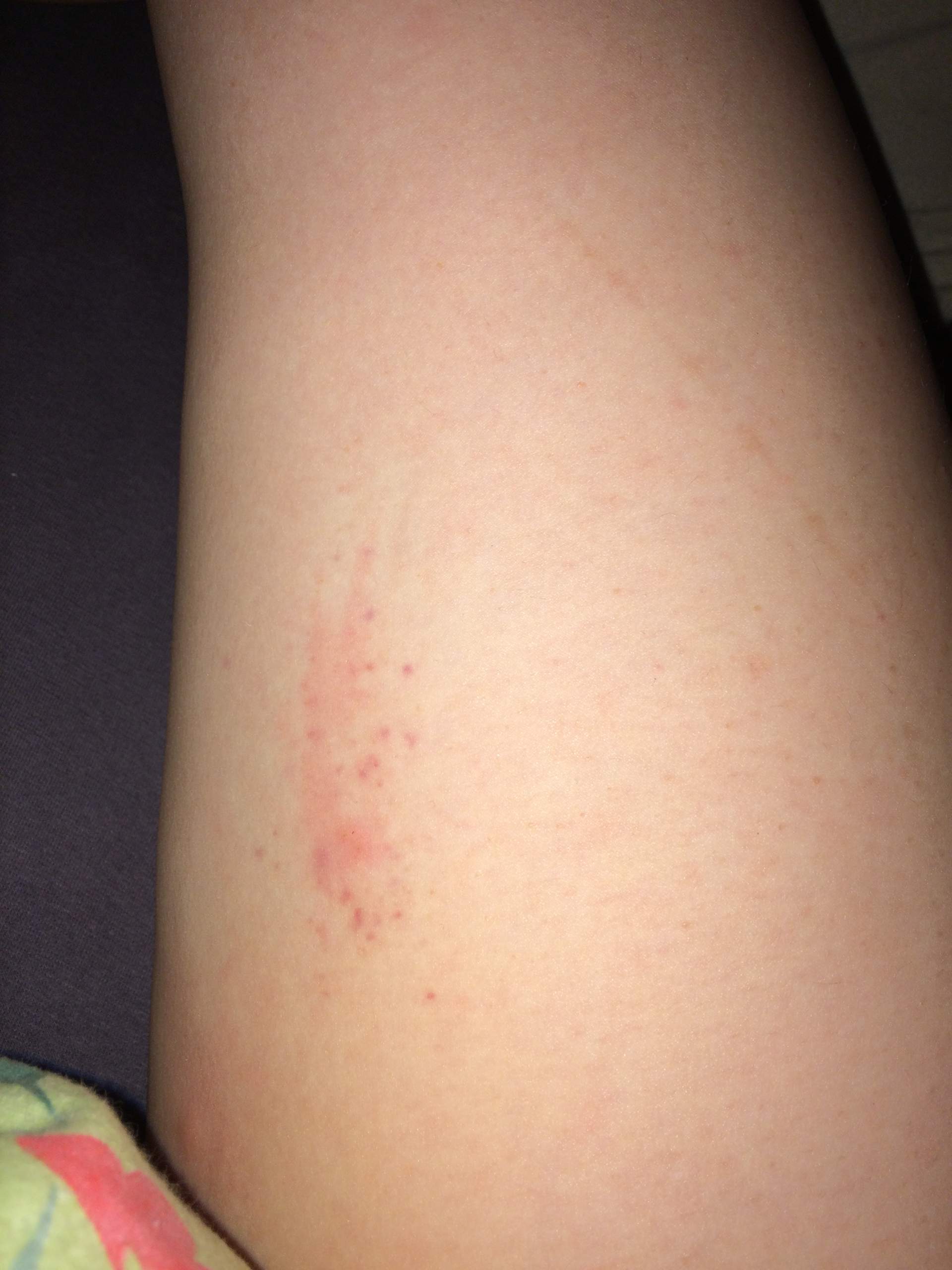 Roter Ausschlag am ganzen Körper (Beine, Bauch, arme? (Gesundheit, Stich) Roter Ausschlag am ganzen Körper (Beine, Bauch, arme? (Gesundheit, Stich)