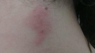 Roter Ausschlag Im Nacken Roter Ausschlag Im Nacken