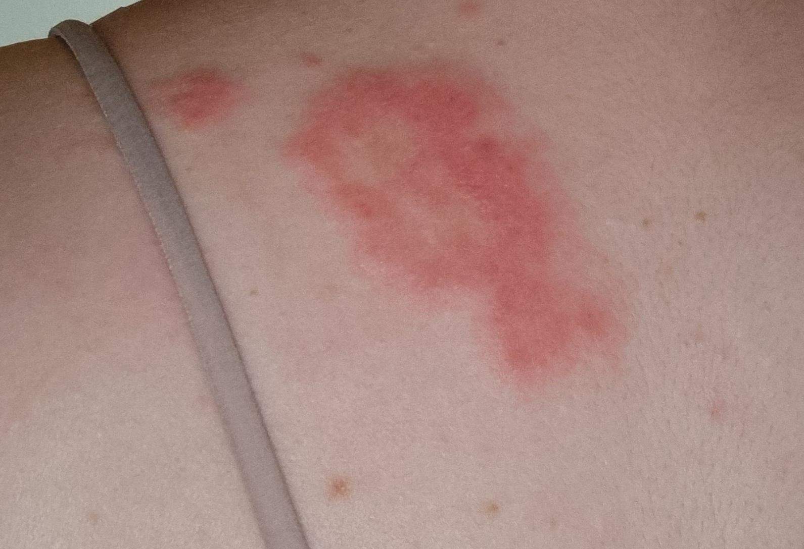 Roter Ausschlag nach Insektenstich? (Gesundheit und Medizin, Stich, jucken)