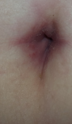 Roter Bauchnabel Selten Schmerzen Gesundheit Und Medizin Bauch Bauchnabelpiercing Roter Bauchnabel Selten Schmerzen Gesundheit Und Medizin Bauch Bauchnabelpiercing