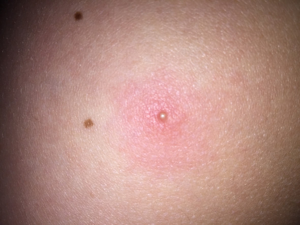 Roter Dicker Pickel Auf Dem Oberschenkel Gesundheit Und Medizin Gross Warm