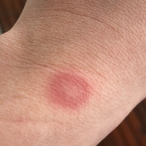 Roter Fleck am Arm  - (Gesundheit und Medizin, Arzt, Krankheit)