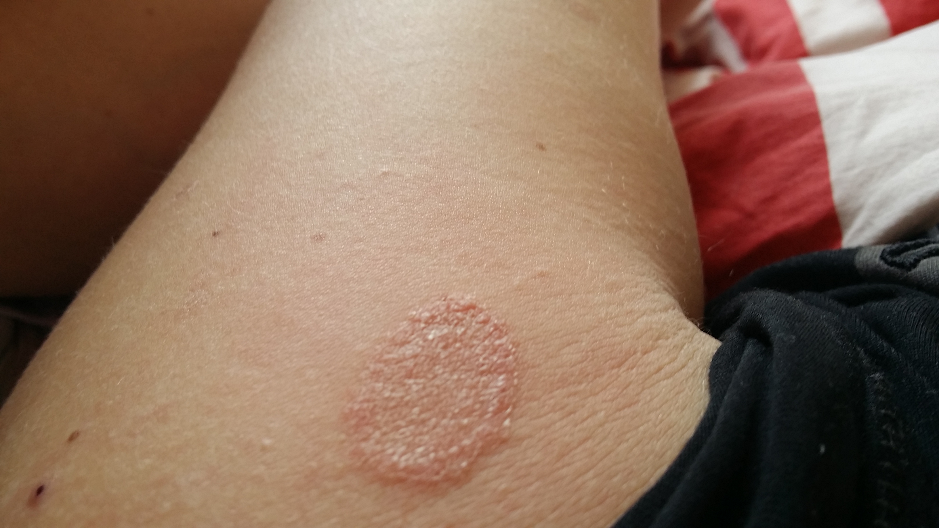 Mein roter Fleck am Arm wird immer größer. Was kann ich tun? (Haut Mein roter Fleck am Arm wird immer größer. Was kann ich tun? (Haut