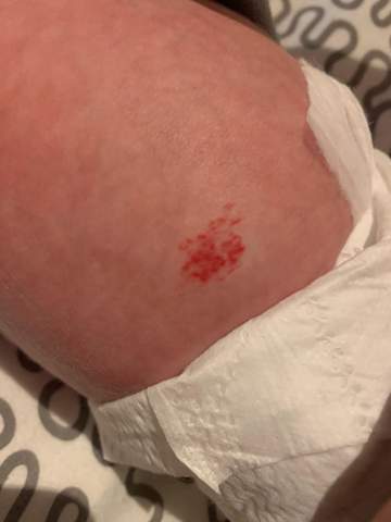 Roter Fleck Am Bauch Eines Sauglings Baby Hauterkrankung Roter Fleck Am Bauch Eines Sauglings Baby Hauterkrankung