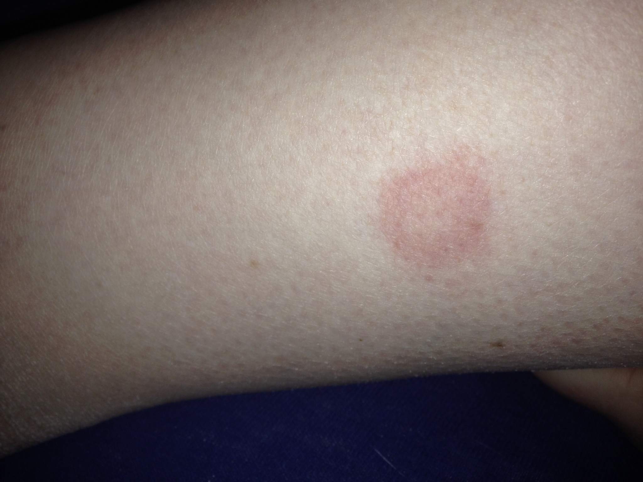 Roter Fleck am Bein (Unterschenkel)? (Haut, roterfleck) Roter Fleck am Bein (Unterschenkel)? (Haut, roterfleck)