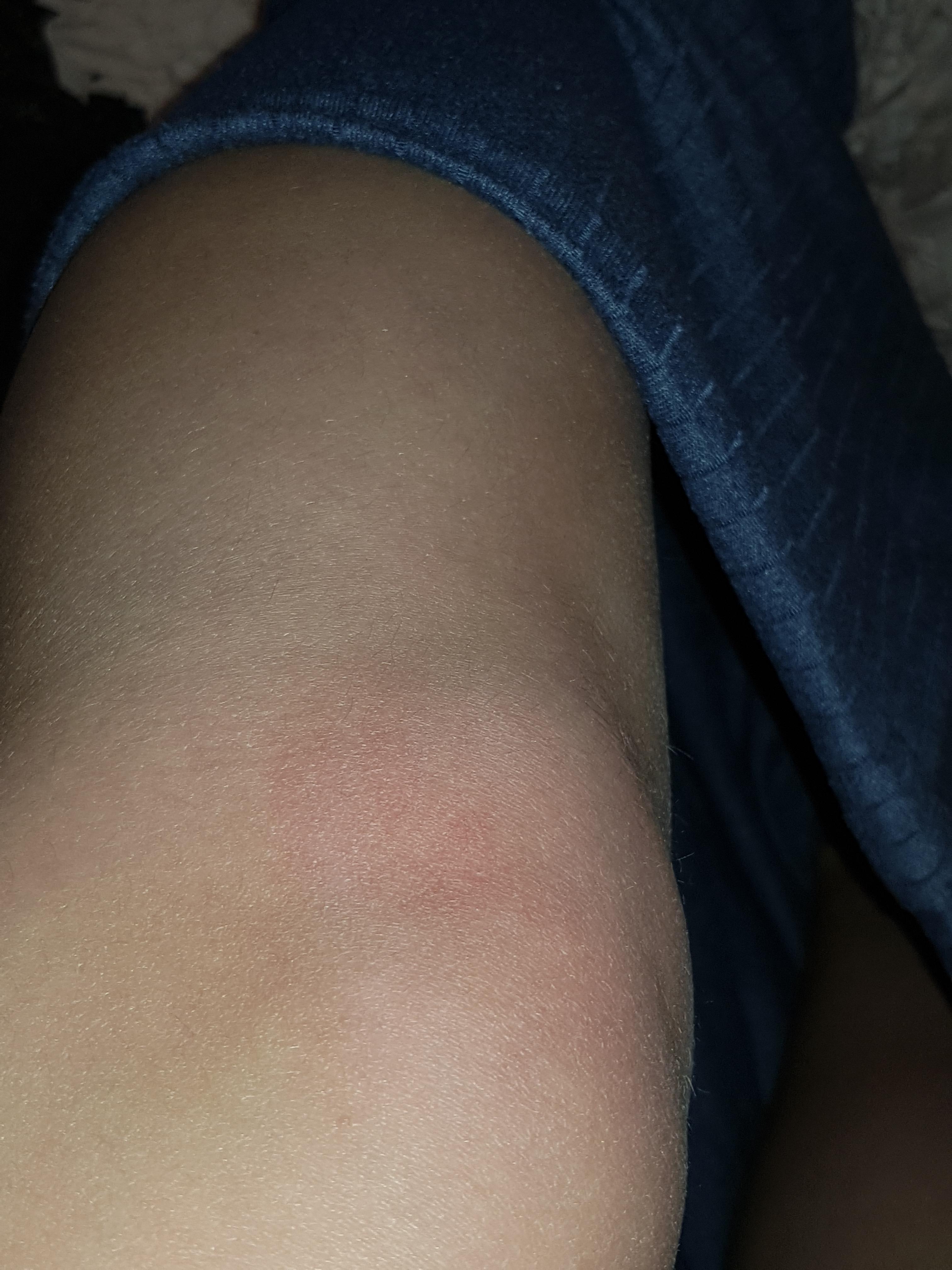 Roter Fleck Am Knie Wad Ist Das Gesundheit Und Medizin Medizin Flecken Roter Fleck Am Knie Wad Ist Das Gesundheit Und Medizin Medizin Flecken
