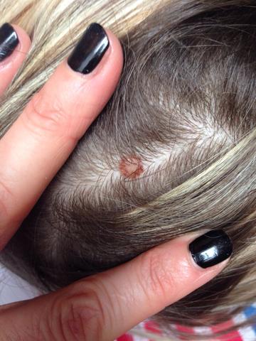 Roter Fleck Am Kopf Gesundheit Roter Fleck Am Kopf Gesundheit