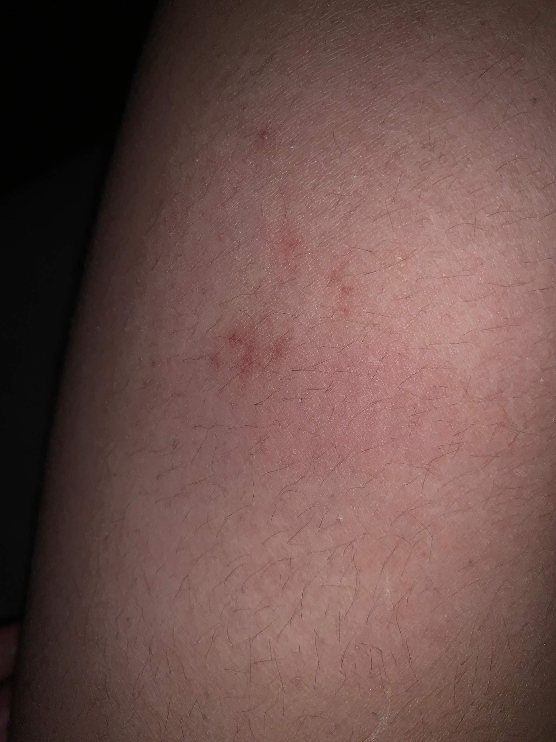 roter fleck an meinem oberschenkel seit nem halben jahr denke ich,was
