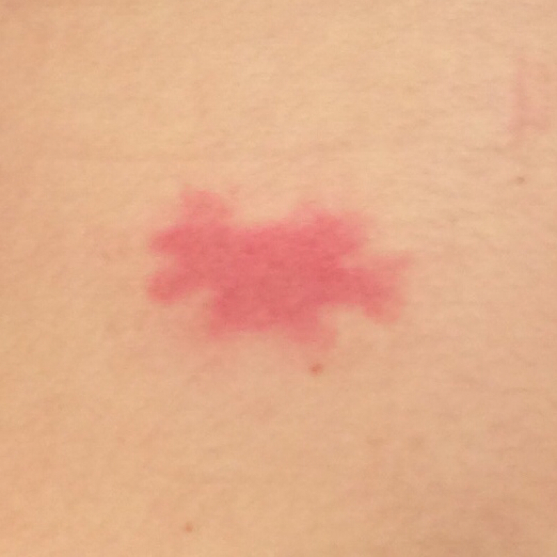 Roter Fleck auf dem Bauch. Was ist das? (Gesundheit, Flecken)