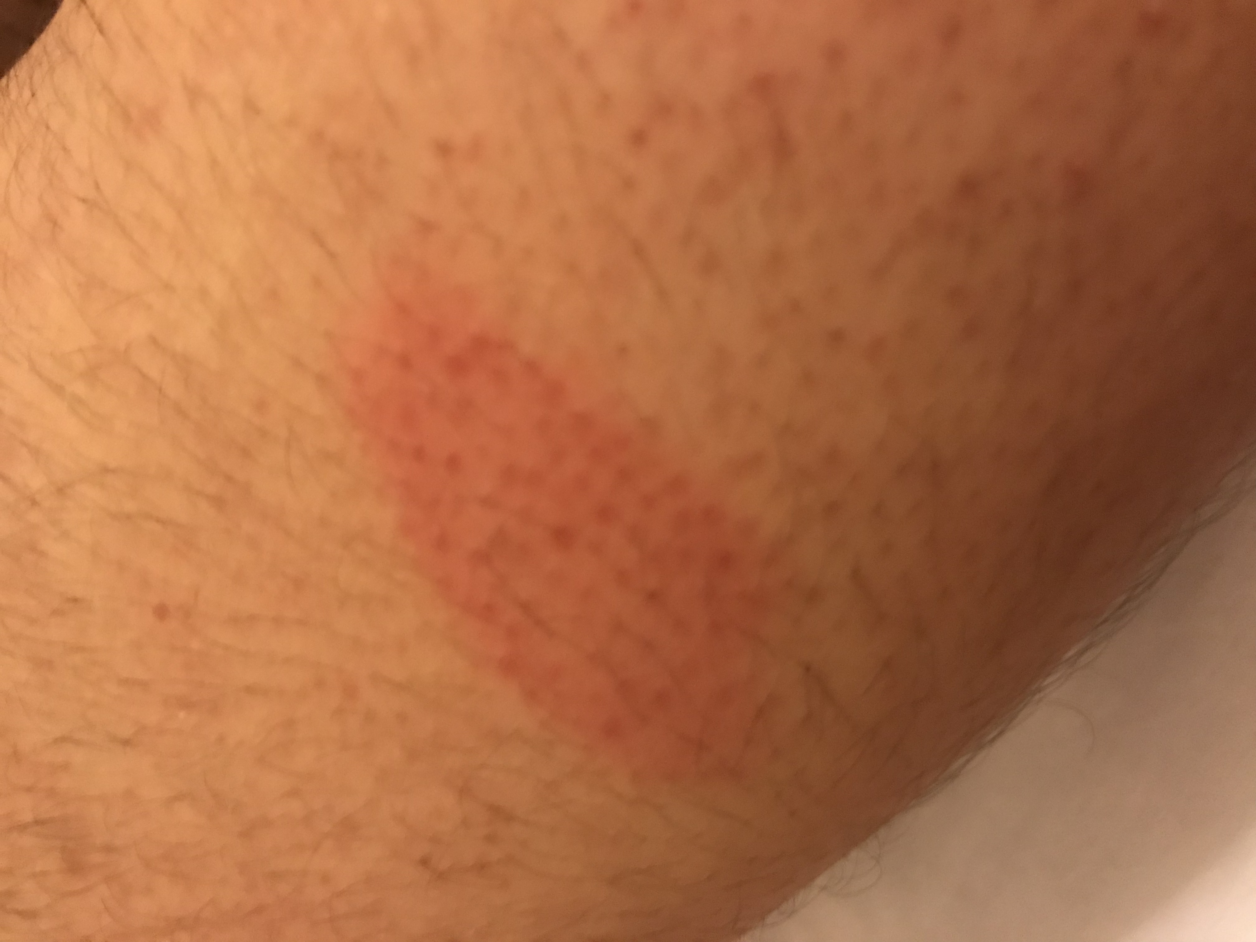 roter Fleck auf dem Unterarm gefährlich? (Gesundheit, Haut, Hautkrebs) roter Fleck auf dem Unterarm gefährlich? (Gesundheit, Haut, Hautkrebs)