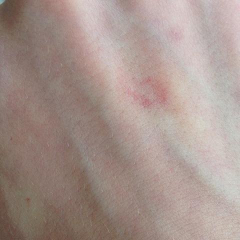 Hier der rote Fleck auf meiner Hand. - (Arzt, Haut, Krebs)