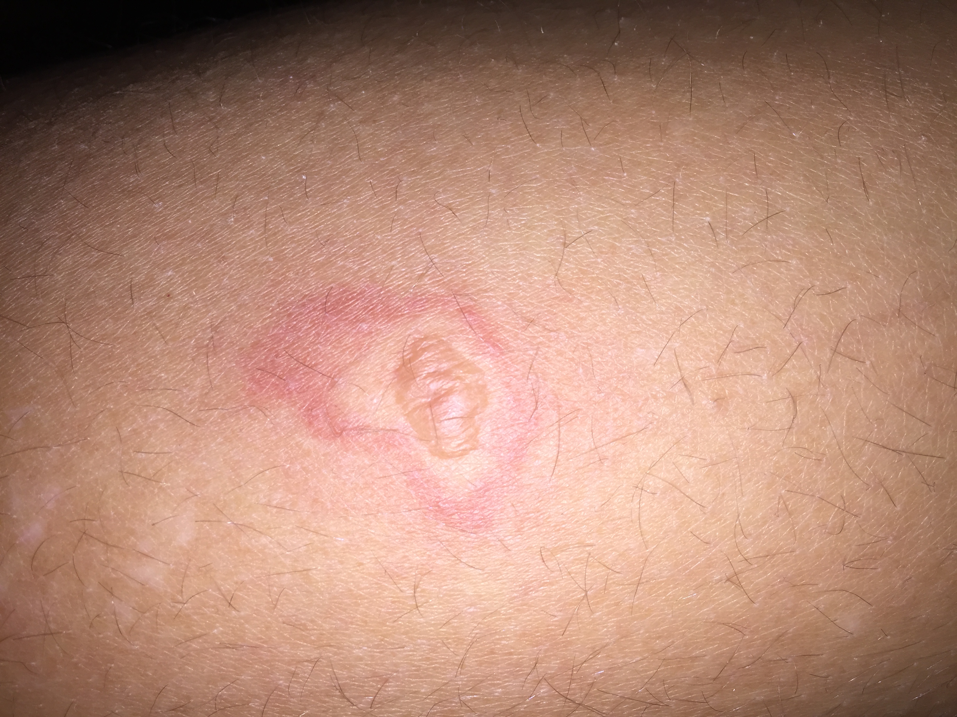 Sollte ich mit diesem roten Fleck auf der Haut ins Krankenhaus
