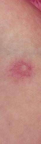 Roter Fleck Auf Meiner Brust Korper Roter Fleck Auf Meiner Brust Korper