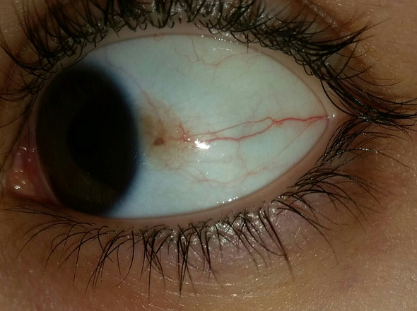 roter Fleck im Auge - (Medizin, Arzt, Augen)