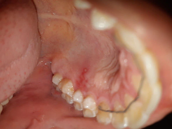 Roter Fleck Mit Bisschen Weiss Beim Gaumen Roter Fleck Mit Bisschen Weiss Beim Gaumen