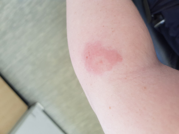 Cubital Rash Insektenstich - die meistgelesenen Fragen
