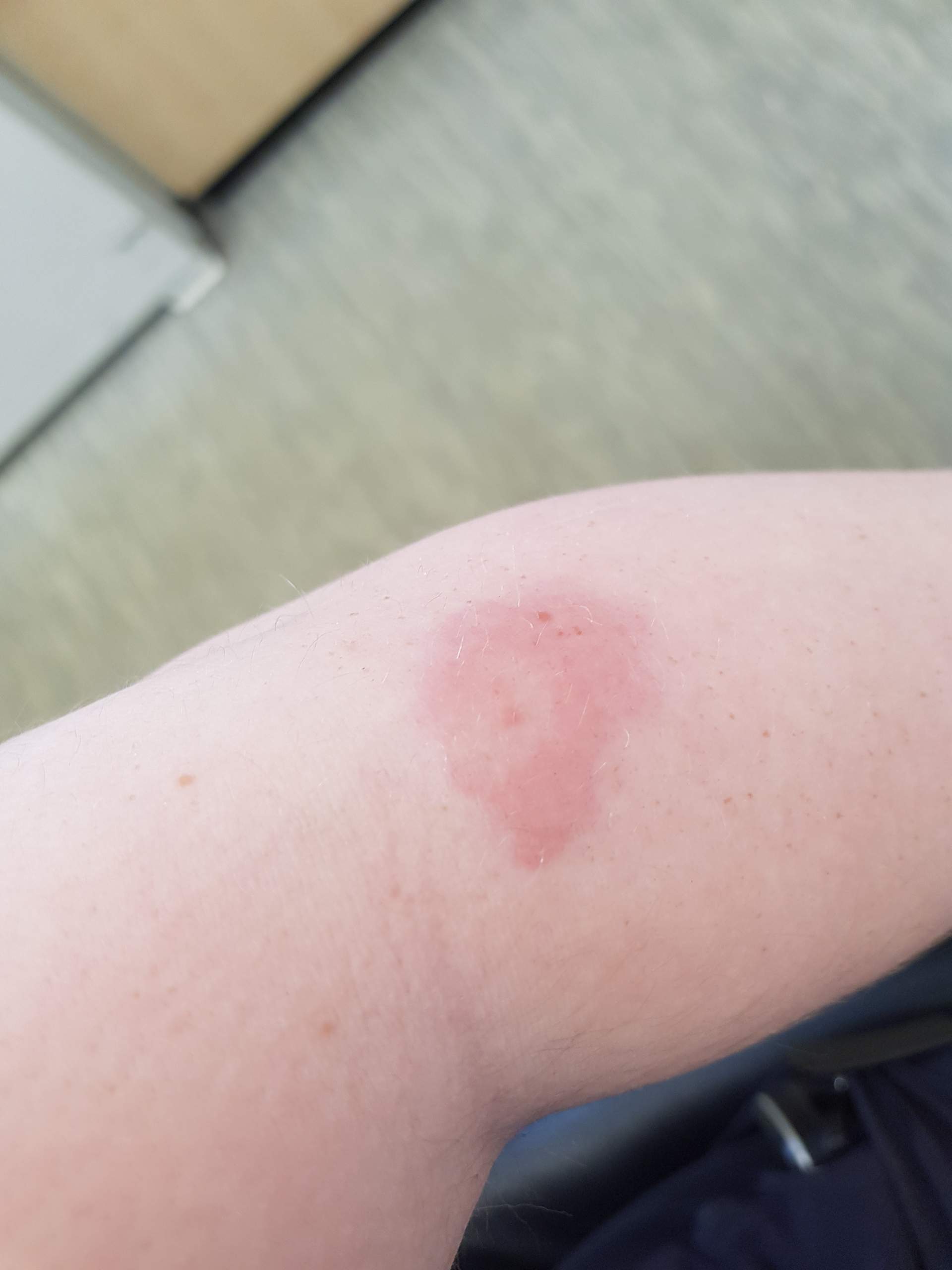 Fleck roter mückenstich großer Insektenstich