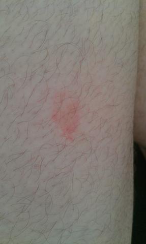 Roter Fleck Mit Rotem Rand An Der Wade Und Am Oberschenkel Gesundheit Medizin Roter Fleck Mit Rotem Rand An Der Wade Und Am Oberschenkel Gesundheit Medizin