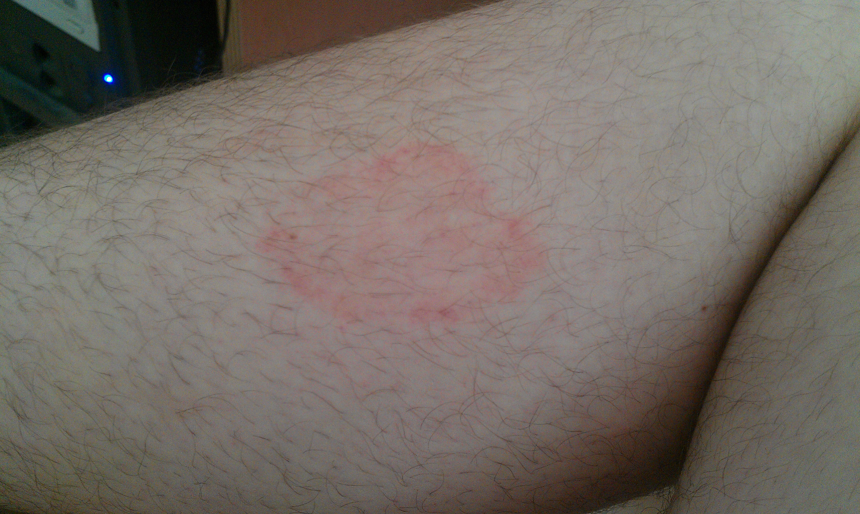 Roter Fleck mit rotem Rand an der Wade und am Oberschenkel (Gesundheit, Medizin)