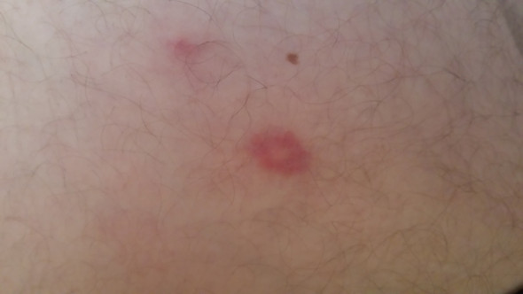 Roter Fleck mit weißer Mitte - (Krankheit, Haut, Pickel)