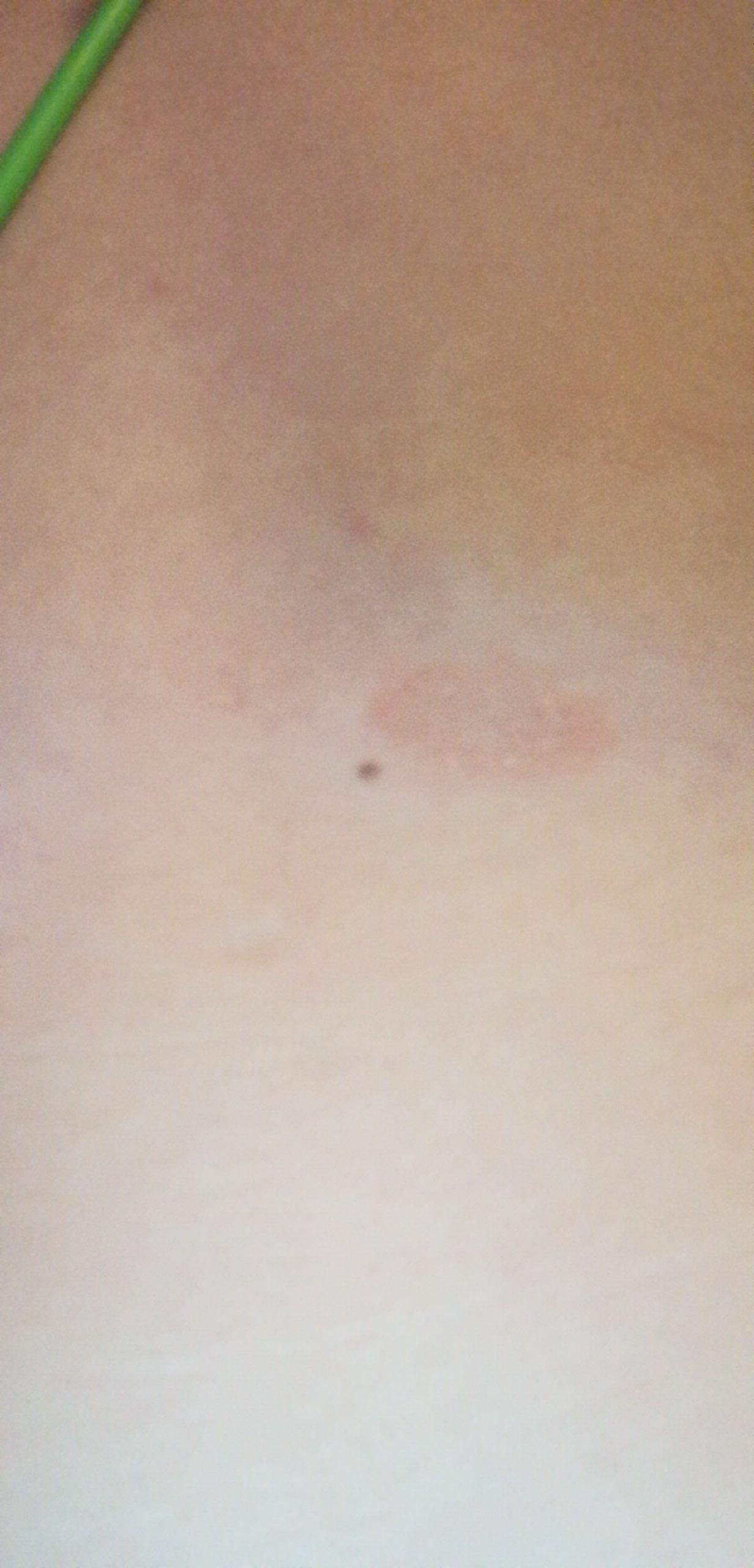 Roter Fleck Unter Der Brust Gesundheit Und Medizin Flecken Roter Fleck Unter Der Brust Gesundheit Und Medizin Flecken