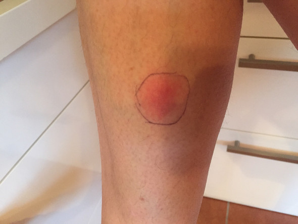 roter fleck wade gesundheit und medizin