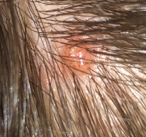 Roter Huckel Auf Der Kopfhaut Kennt Sich Jemand Aus Gesundheit Haare Hautarzt
