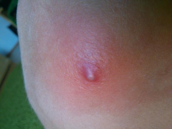 Roter Knubbel Am Knie Was Ist Das Haut Roter Knubbel Am Knie Was Ist Das Haut