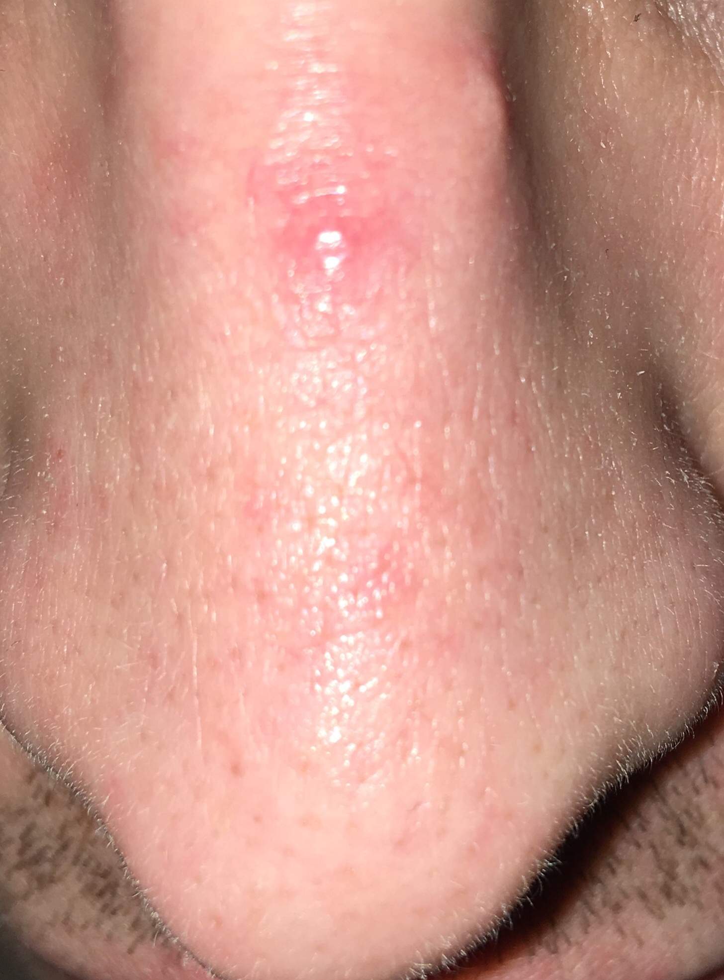 Roter Knubbel auf dem Nasentücken? (Gesundheit und Medizin, Medizin, Pickel)