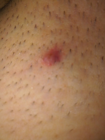 roter knubbel im intimbereich