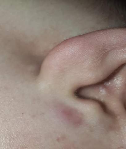 Roter Knubbel Unterm Ohr Gesundheit Und Medizin Gesundheit Korper