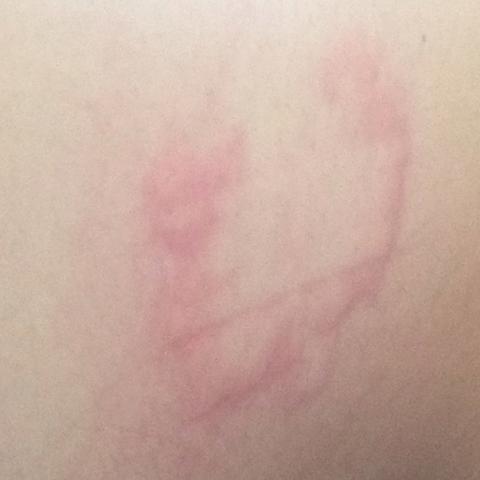 Roter Komischer Fleck Am Rucken Hilfe Es Juckt So Sehr Was Ist Das Echt Angst Brennen Jucken