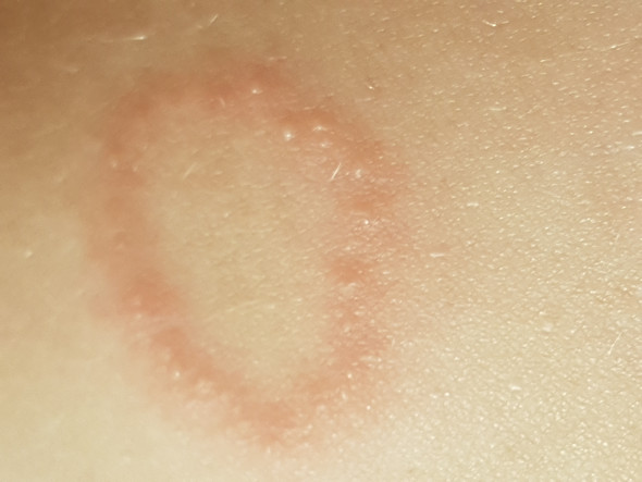 Roter Kreis Am Arm Gesundheit Und Medizin Krankheit Roter Kreis Am Arm Gesundheit Und Medizin Krankheit