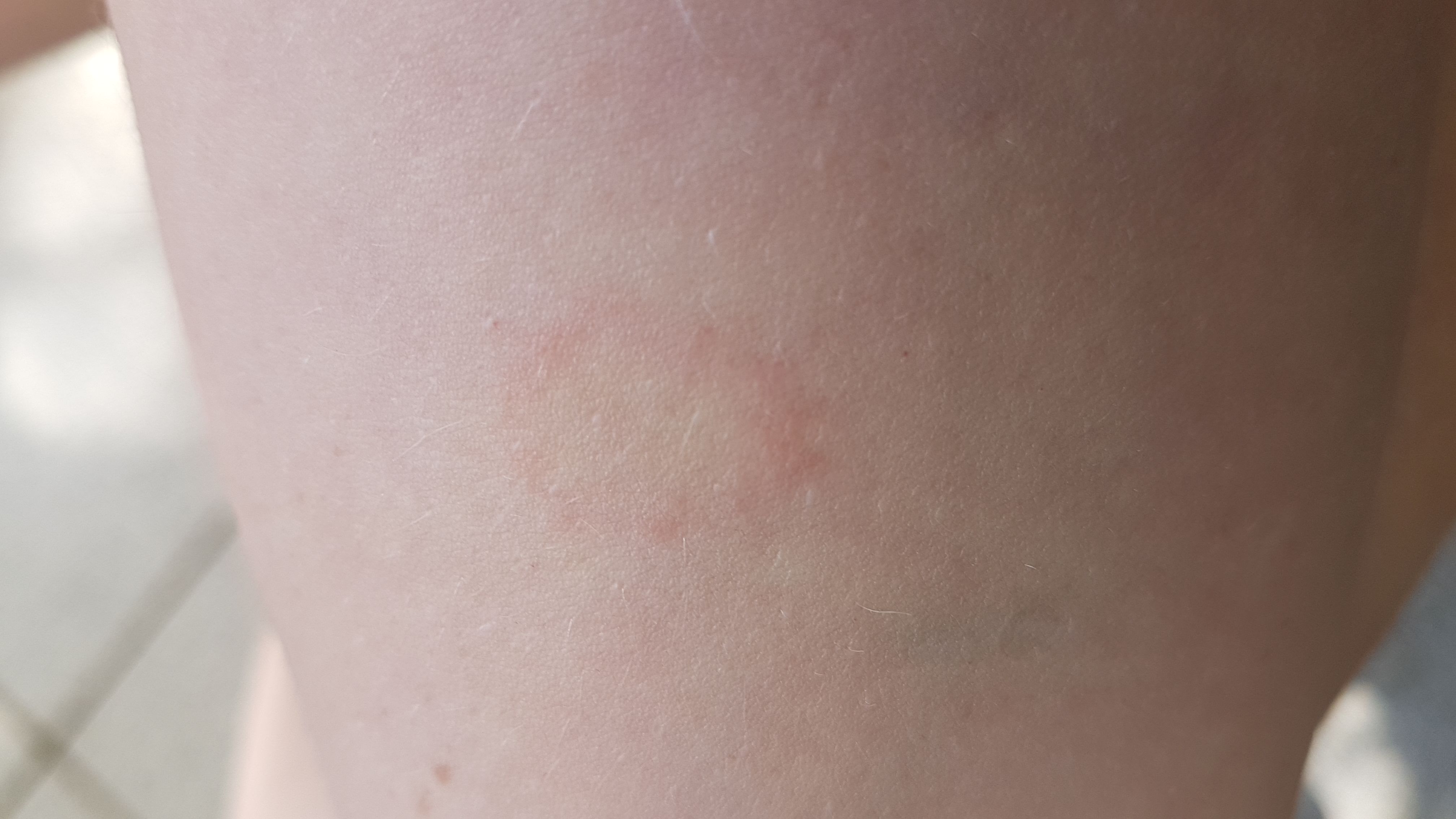 Rote Kreis Auf Der Haut