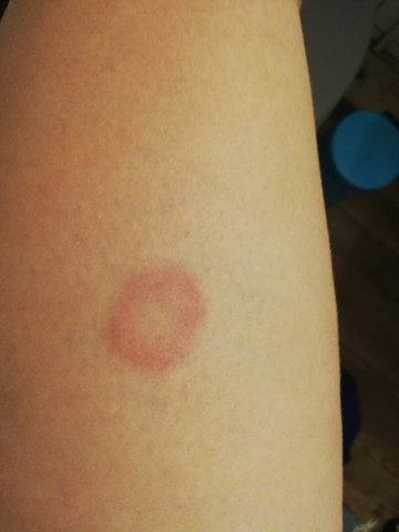 Roter Kreis Am Bein Was Kann Das Sein Medizin Entzundung Roter Kreis Am Bein Was Kann Das Sein Medizin Entzundung