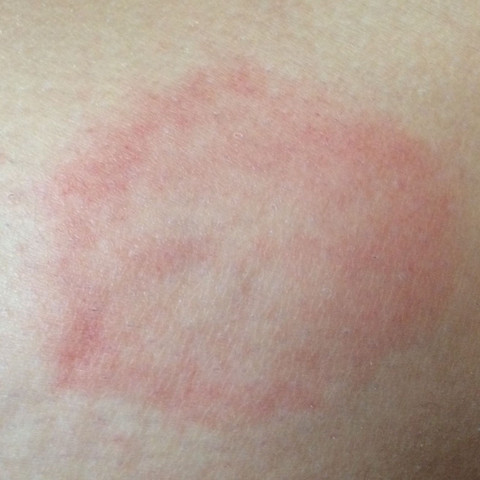 Roter Kreis am Bein? (Beine, rot, Unterschenkel)