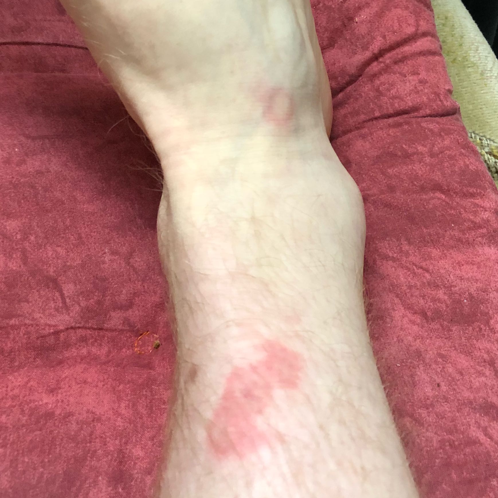 Roter Kreis Haut/ Fuß? (Gesundheit und Medizin, Füße, Beine)