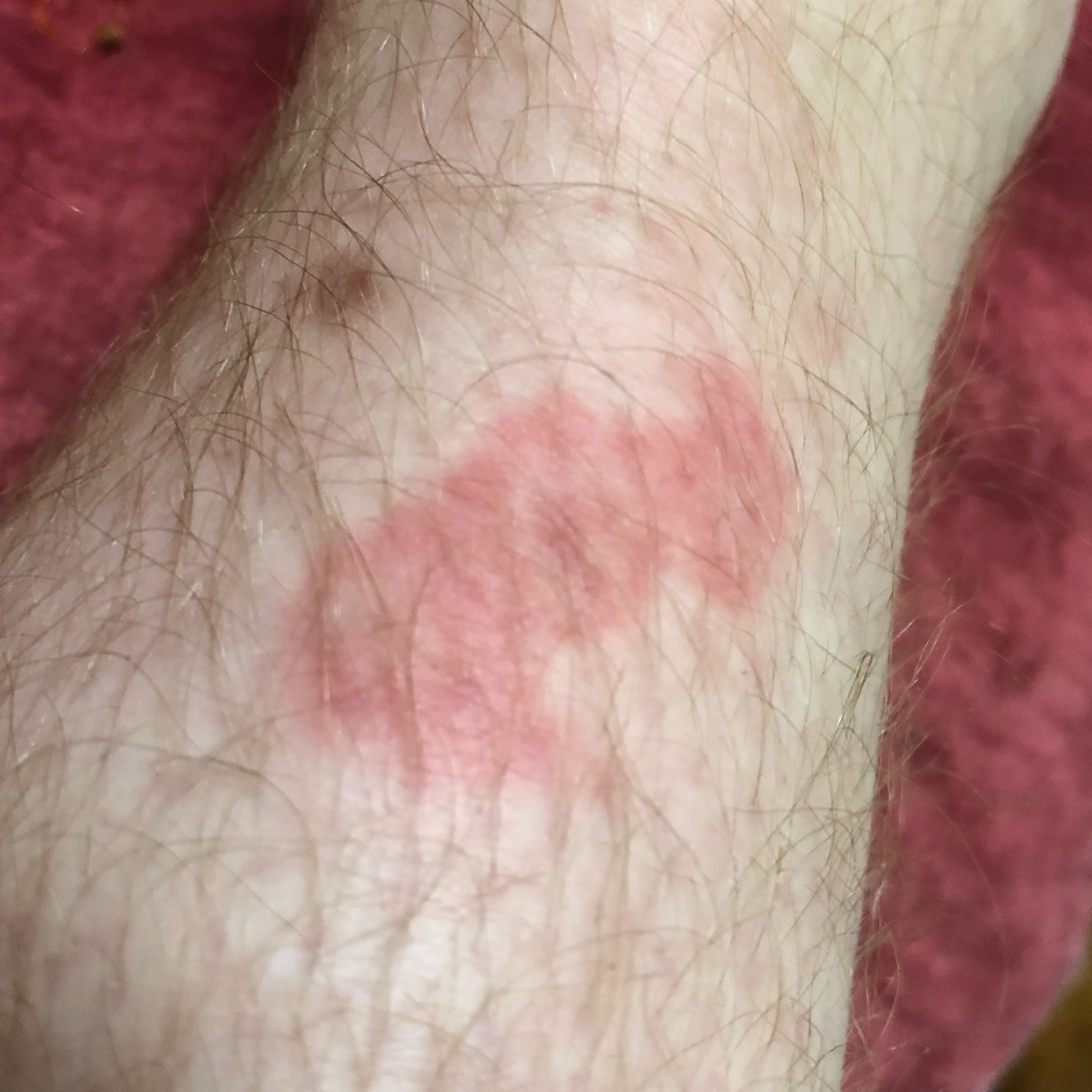 Roter Kreis Haut/ Fuß? (Gesundheit und Medizin, Füße, Beine)